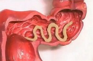 treatment of worms