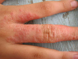 Skin rash in worms