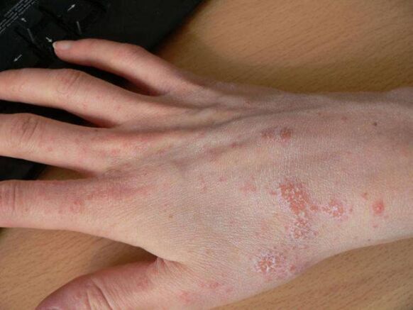 scabies on the hand with a subcutaneous tick